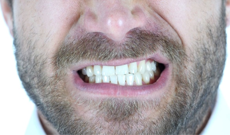 what is bruxism